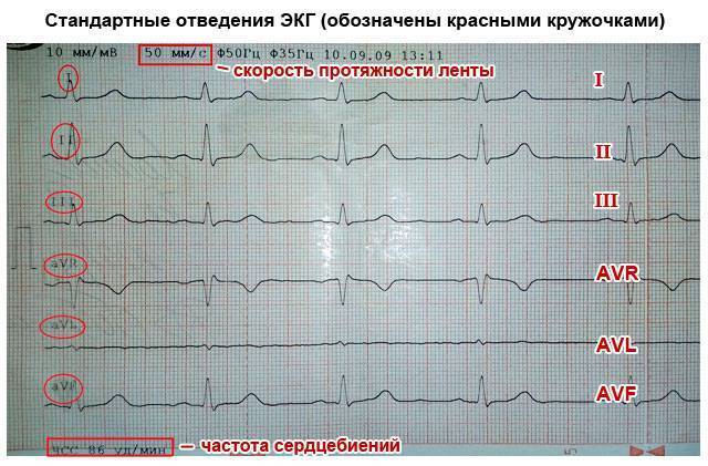 Расшифровка результатов ЭКГ у ребенка: нормы показателей и причины нарушений