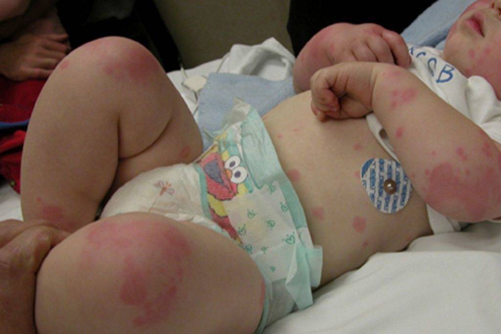 Крапивница у детей: фото, симптомы и лечение до 3 лет и старше, профилактика