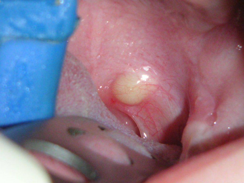 Белая точка на десне у грудничка (прыщик): все о "жемчужинках" во рту ребенка