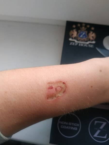 Ожог у ребенка: лечение термических повреждений разной степени и первая помощь в домашних условиях