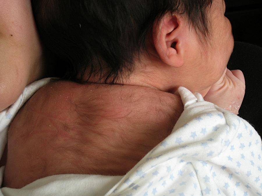 Щетина у новорожденных или кочерга: фото на ушах, спине, теле