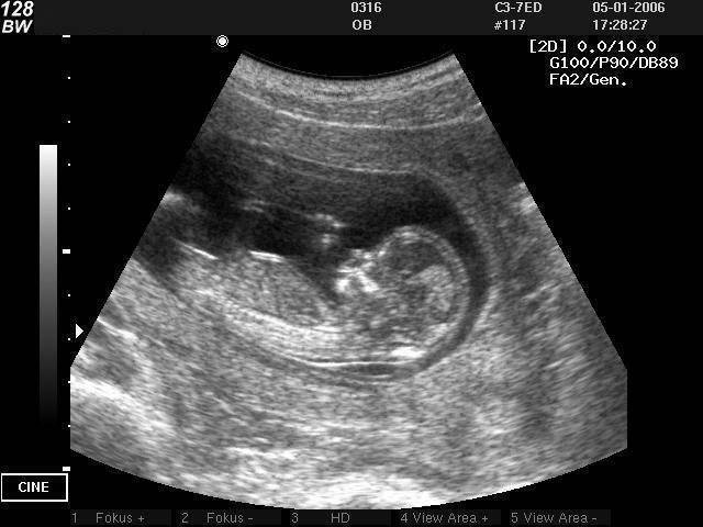 БПР плода по неделям беременности: норма бипариентального размера головы и других показателей на УЗИ