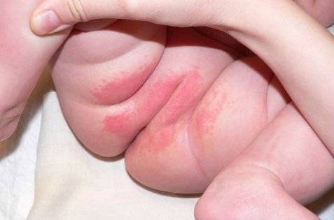 Сыпь в паху у ребенка - раздражение в интимной зоне, покраснение и зуд на половых органах