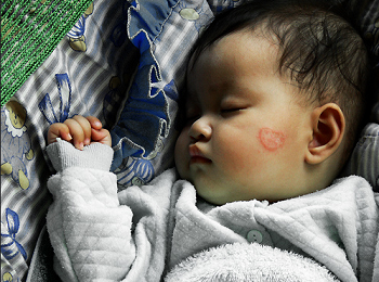 Как узнать на что аллергия у ребенка: способы определения потенциального аллергена