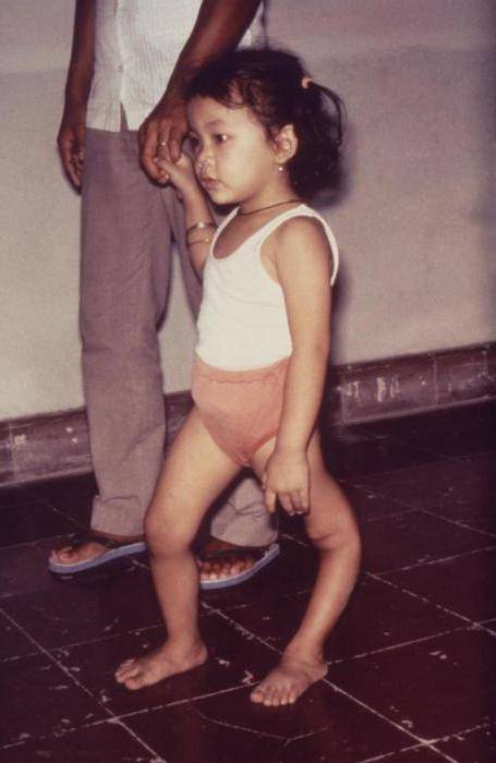 Прививка от полиомиелита: реакция у ребенка, последствия, осложнения, противопоказания