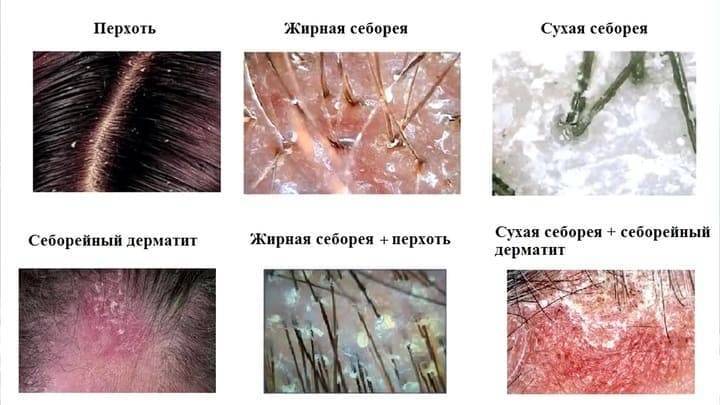 Средства для увлажнения кожи ребенка - лечение атопического дерматита народной медициной