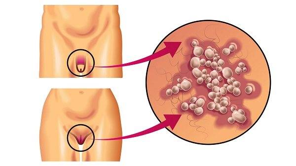 Герпес у детей: виды вируса, симптомы заболеваний, лечение и профилактика