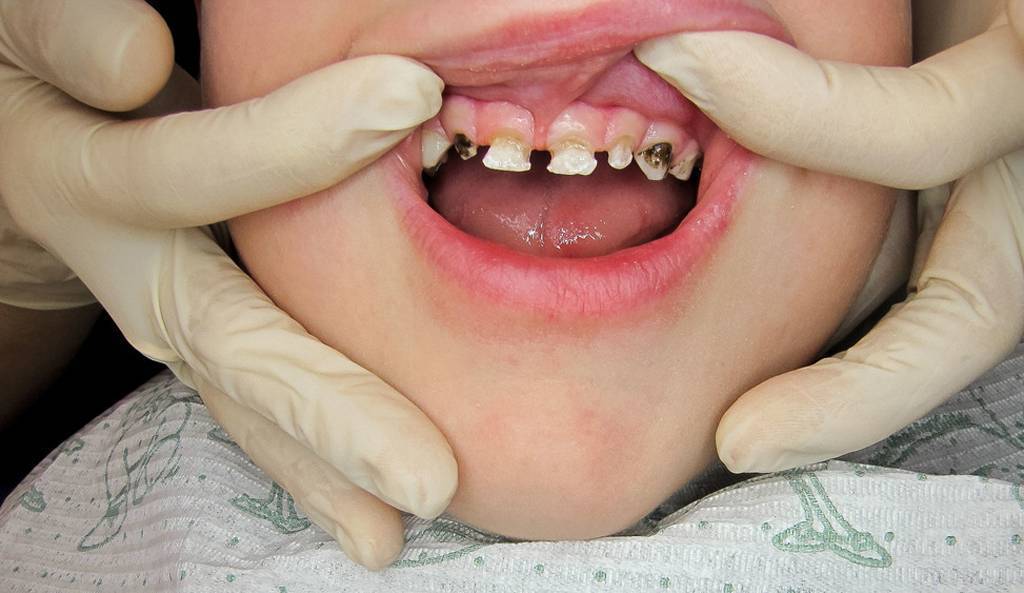 Кариес у детей: фото молочных зубов, лечение и профилактика болезни в раннем возрасте