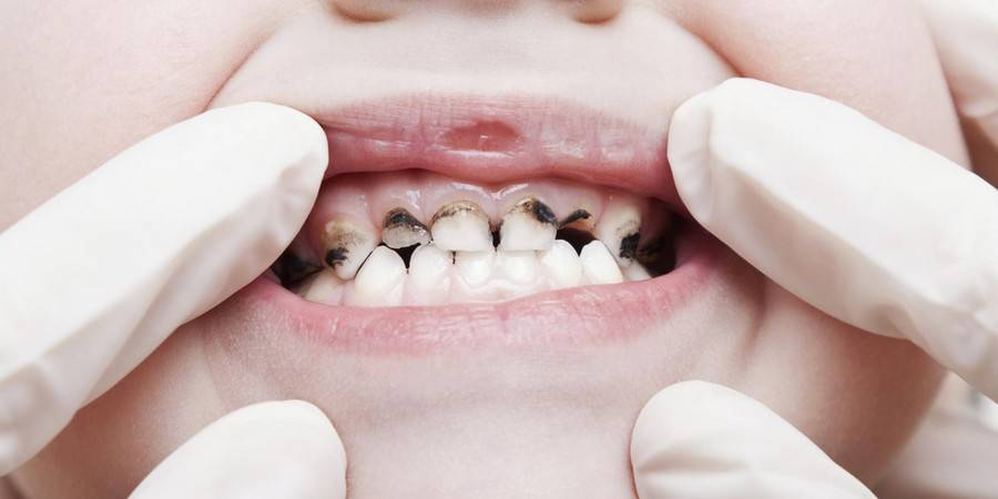 Серебрение зубов у детей - фото до и после, фторирование как альтернатива