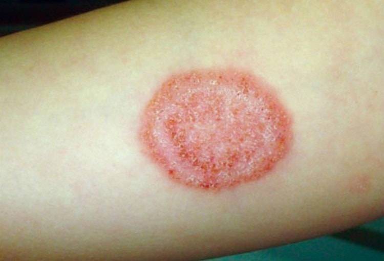 Стригущий лишай у детей на голове: фото, признаки и лечение в домашних условиях