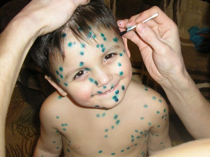 Сколько дней мазать ветрянку зеленкой у ребенка? чем мазать ветрянку, кроме зеленки: обзор лучших мазей, гелей и других бесцветных средств для обработки корочек у детей.