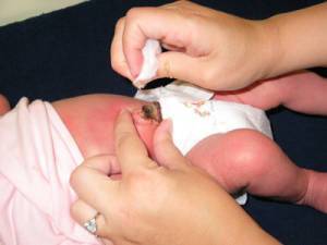 Кровит пупок у новорожденного: что делать, почему кровоточит на 2-3 неделе?