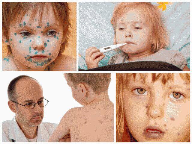 Чем лечить ветрянку у детей в домашних условиях: быстро и пошагово