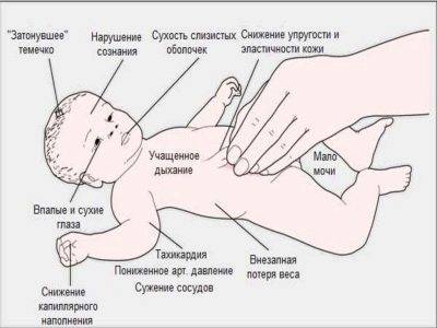 Пилороспазм у новорожденных: симптоматика, диагностика и лечение у детей, отличие от пилоростеноза