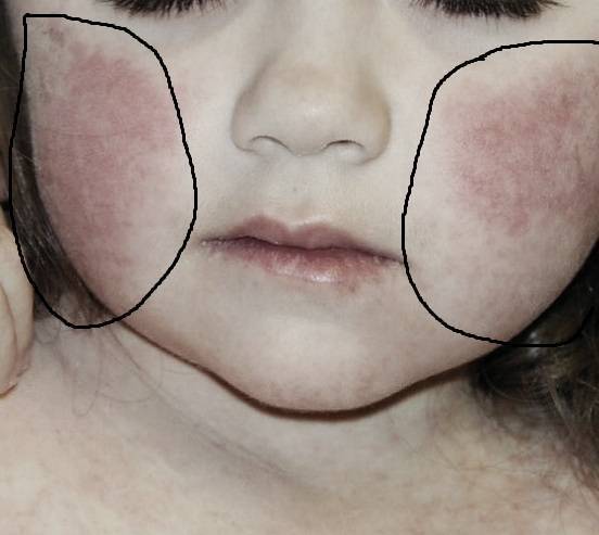 Шершавые пятна на теле у ребенка (на коже ног и рук, на спине и лице): фото