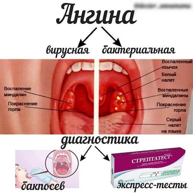 3 схемы лечения лакунарной ангины, симптомы