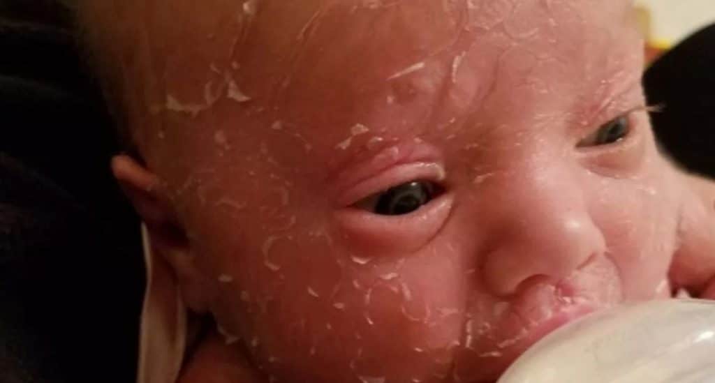 Ихтиоз кожи у детей: опасно ли это заболевание для новорожденных, что делать и как лечить?