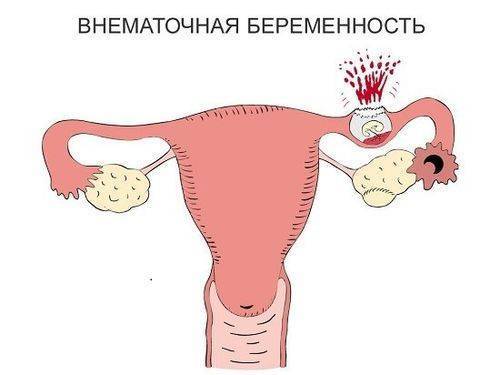 Бежевые выделения при беременности на ранних сроках светлого, желтого или коричневого оттенка