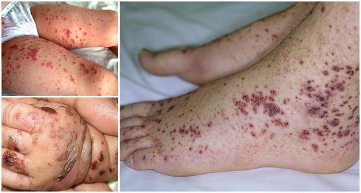 Причины возникновения геморрагического васкулита у детей, симптомы и лечение