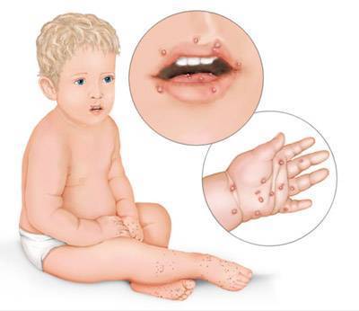 Вирус Коксаки у детей: фото, симптомы в инкубационный период, лечение