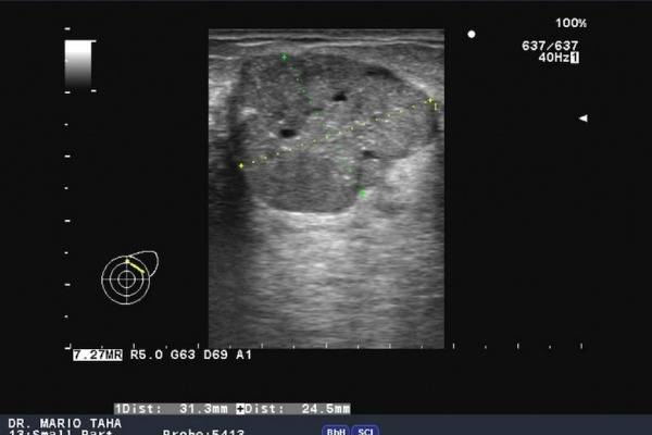 Ультразвук при лактостазе, физиотерапия: можно ли делать УЗИ при грудном вскармливании?