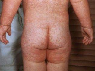 Сыпь в паху у ребенка - раздражение в интимной зоне, покраснение и зуд на половых органах