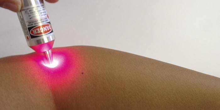 Контагиозный моллюск у детей: фото на коже, лечение и удаление на разных стадиях болезни