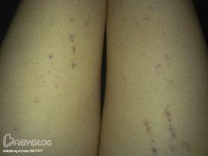 Синяки на ногах у ребенка без причины - что это и почему постоянно появляются пятна?