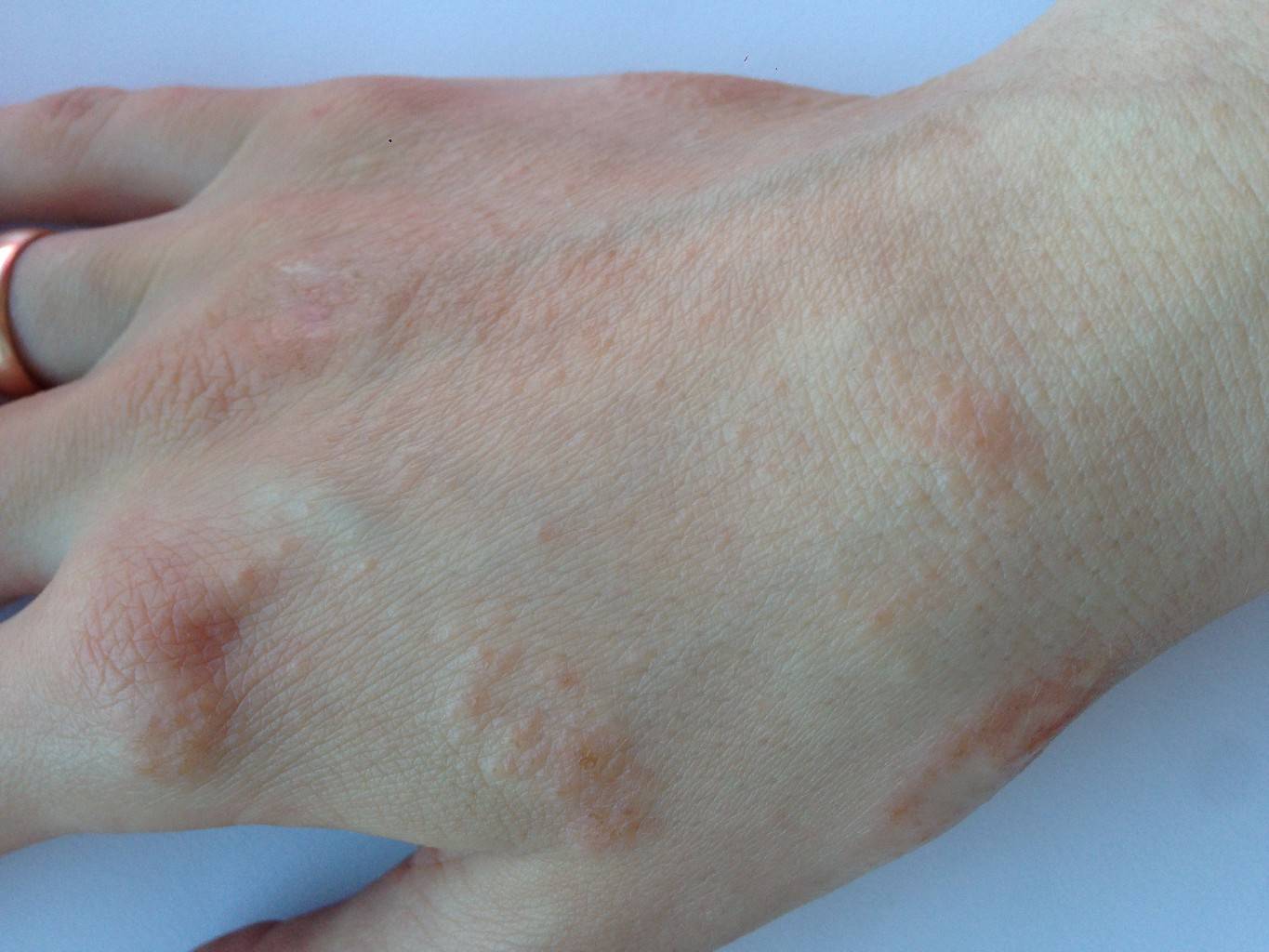 Шелушатся пятки у ребенка: причины шелушения и как избавиться