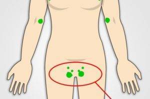 У ребенка увеличился лимфоузел в паху: причины воспаления у мальчиков и девочек