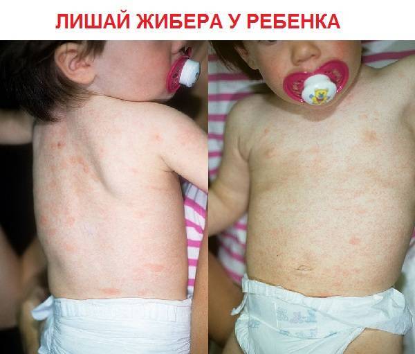 Розовый лишай у ребенка: фото, признаки и лечение в домашних условиях