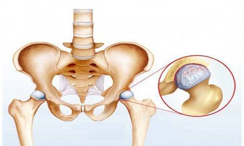 Воспаление тазобедренного сустава у ребенка - симптомы, причины и лечение артрита