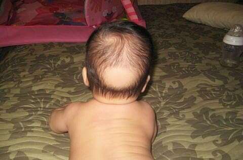 У ребенка выпадают волосы - что делать, почему это происходит, какое необходимо лечение?