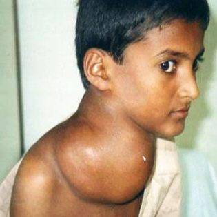 У ребенка опухла шея с одной стороны под ухом: причины, сопутствующие симптомы и лечение