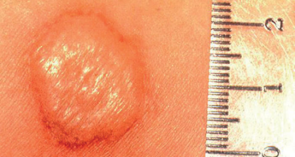 Как уменьшить Манту на руке в домашних условиях - можно ли мазать "Фенистилом" и другими средствами?