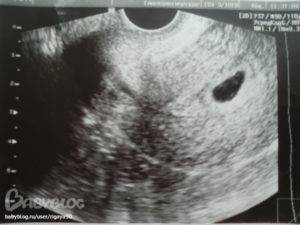 Пустое плодное яйцо или анэмбриония: причины, симптомы и методы диагностики отсутствия эмбриона