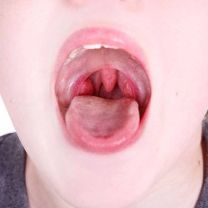 Масло туи при аденоидах, насморке для детей: инструкция по применению