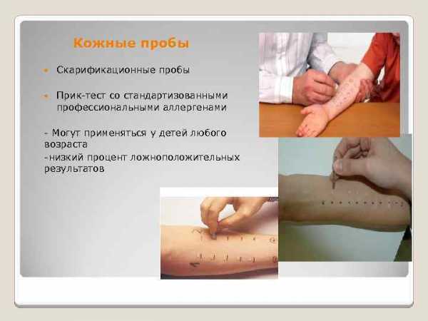 Аллергопробы для детей: с какого возраста, показания