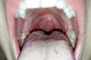 Рыхлое горло у ребенка - что это значит и чем лечить заболевание?