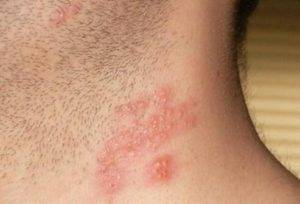 Опоясывающий лишай у детей - симптомы и лечение вируса герпес Зостер