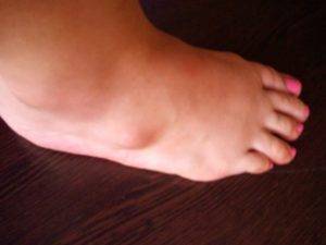Шишка на ноге у ребенка сбоку стопы: фото гигромы и других образований
