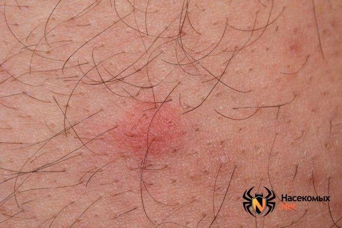 Чем мазать укусы блох у детей: симптомы и лечение аллергии, фото, обработка кожи