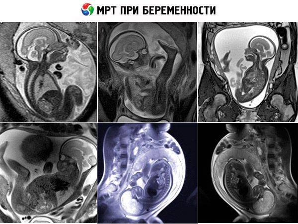 Можно ли делать МРТ беременным на ранних и поздних сроках: томография головного мозга, позвоночника
