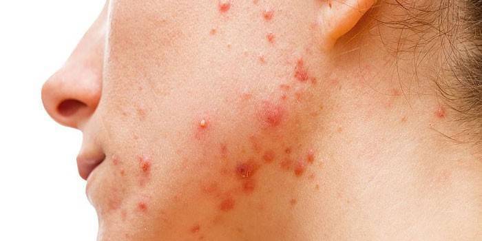 Гидрокортизоновая мазь: инструкция по применению для детей при лечении глаз