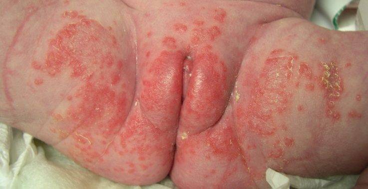 Выделения у девочек от 3 лет: причины и лечение в разном возрасте