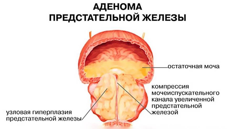 Липоидные тельца в спермограмме, макрофаги, кристаллы спермина и другие объекты в сперме