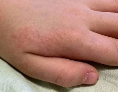 Мелкая сыпь на руках и ногах у ребенка: виды и фото прыщиков с пояснениями