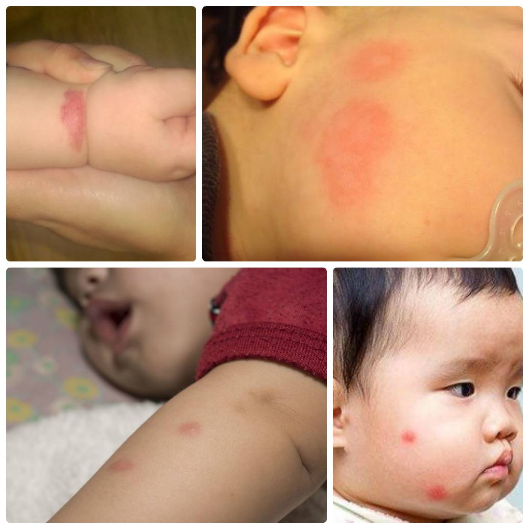 У ребенка после укуса комара появились шишки - что делать и как лечить большие припухлости?