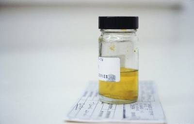 Ураты в моче у ребенка: причины появления кристаллов солей и диета при уратурии