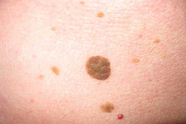 Когда у детей появляются родинки: в каком возрасте, можно ли удалять, к кому обратиться?